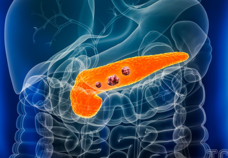 Рак підшлункової залози: симптоми, методи лікування та рекомендації фахівця